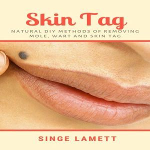 Skin Tag : Natural DIY Methods of removing Mole, Wart and Skin Tag, Singe Lamett