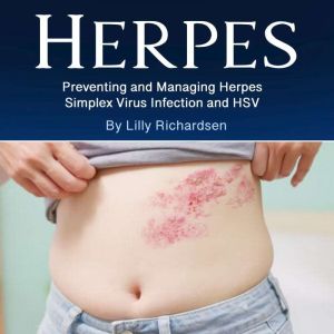 Herpes: Preventing and Managing Herpes Simplex Virus Infection and HSV